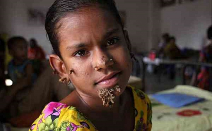 Niña con el síndrome del hombre árbol 