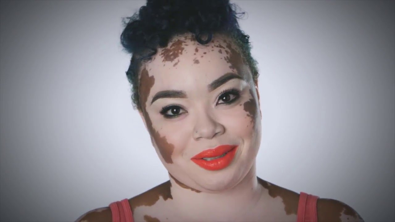 Personas con vitiligo 