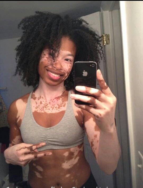 Personas con vitiligo 