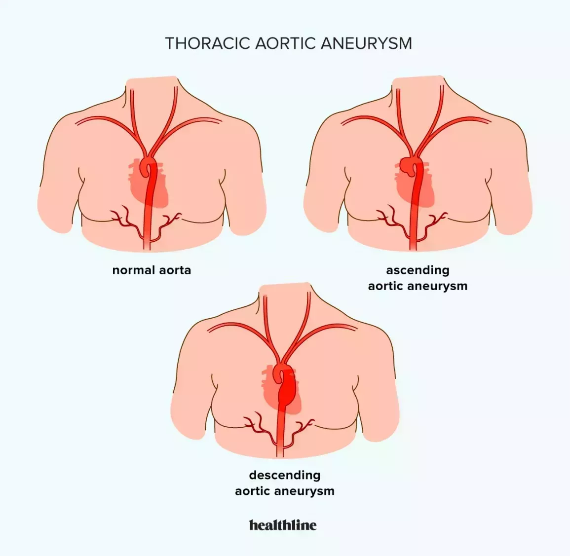 an illustration of a normal aorta compared with an aorta with an ascending thoracic aneurysm and a descending thoracic aortic aneurysm 