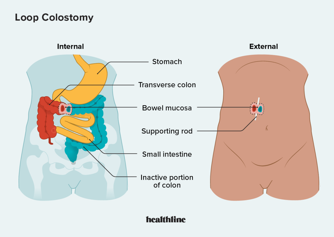 Loop Colostomy drawing