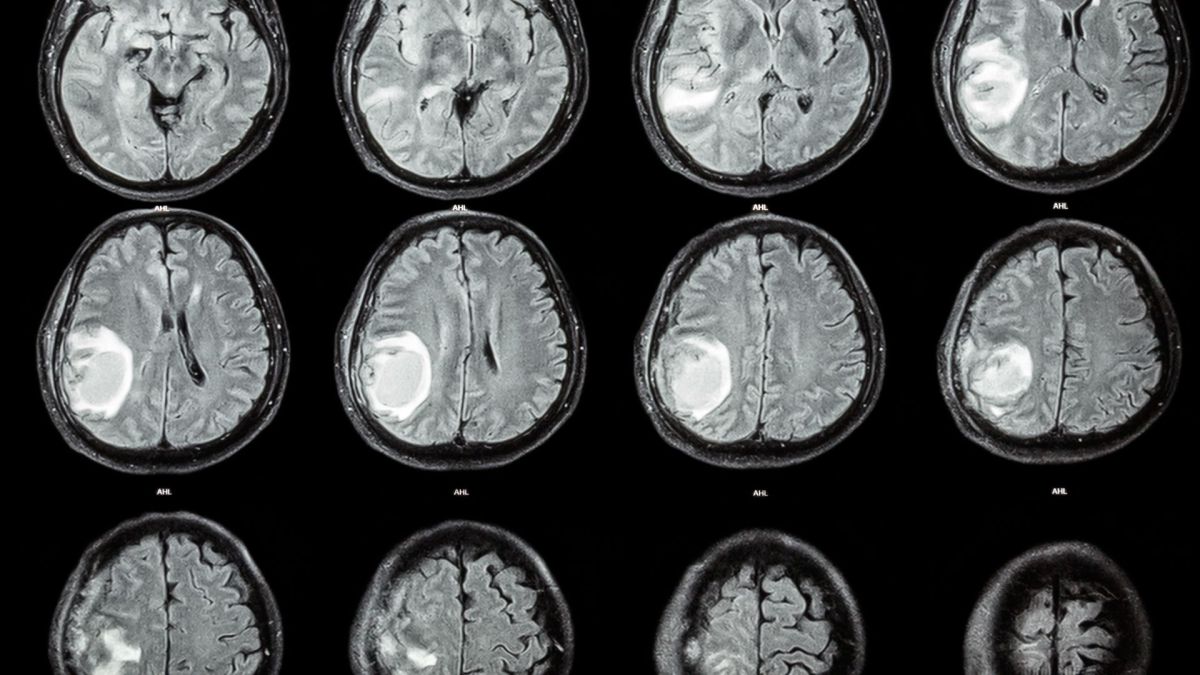 En un caso extremadamente raro, los médicos extraen un feto del cerebro de un niño de 1 año