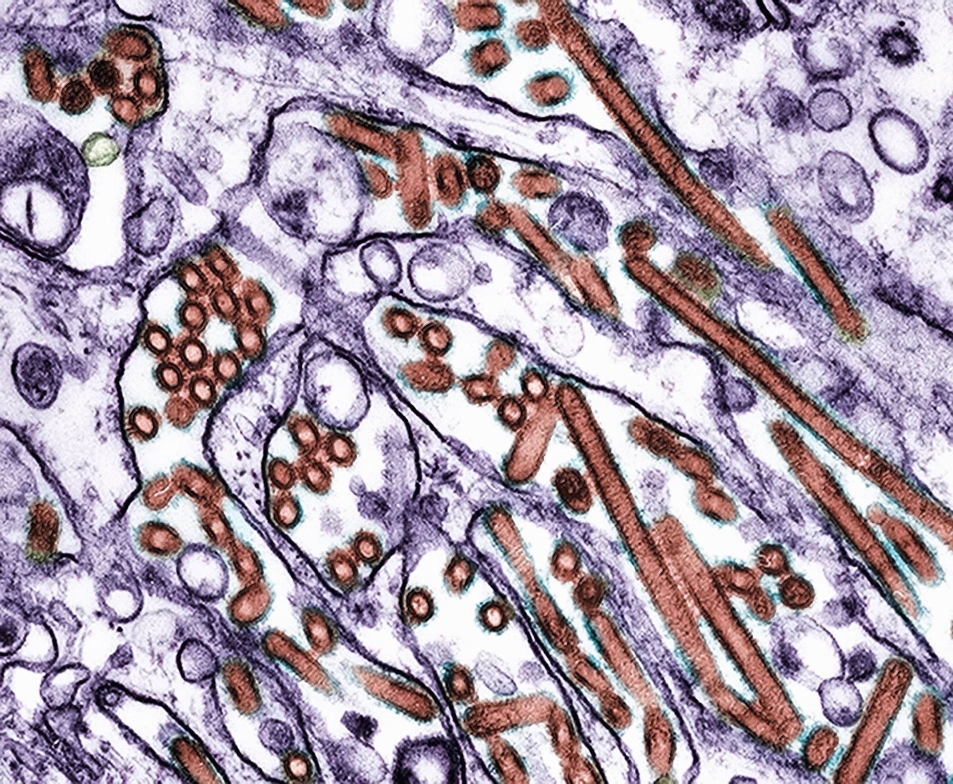 Médicos de Enfermedades Infecciosas Preocupados por la Primera Muerte por Gripe Aviaria en EE.UU.