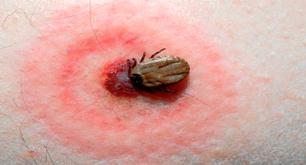 ¿Qué es la enfermedad de Lyme y cuáles son sus síntomas?