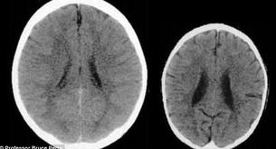 Así afecta la falta de amor al cerebro